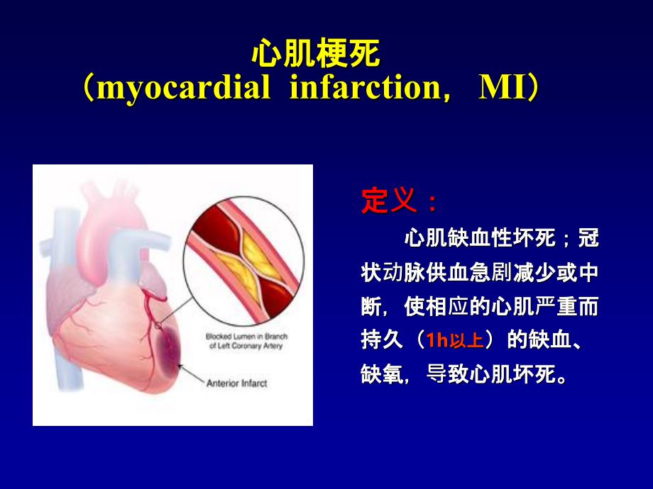 心肌梗死PPT课件_第3页