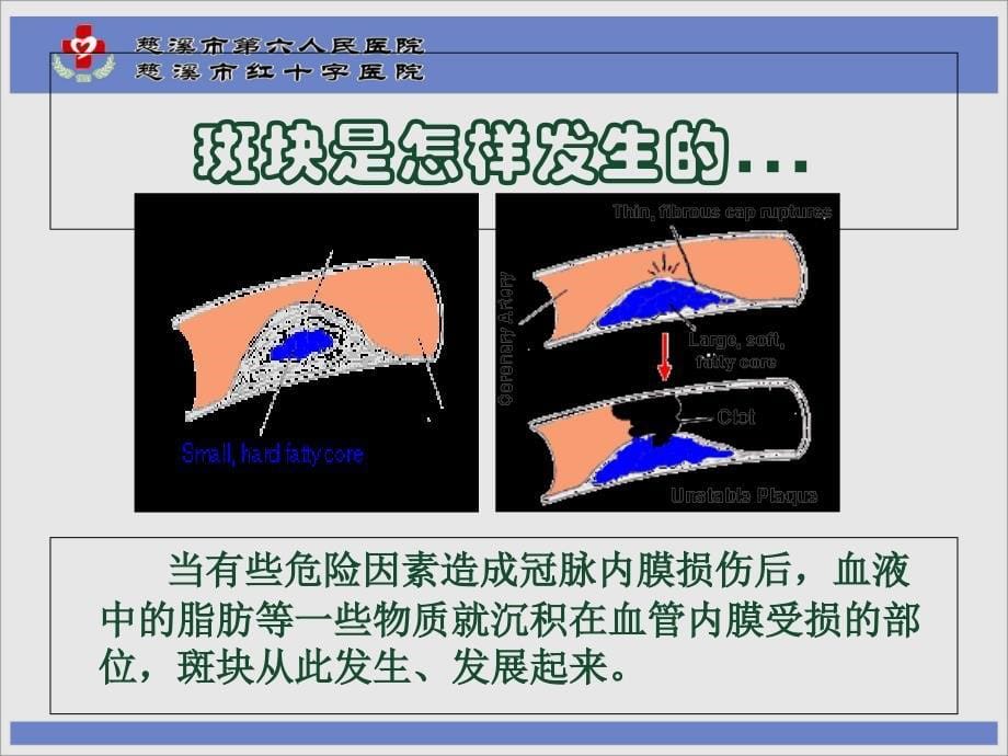 冠心病护理要点幻灯片课件_第5页