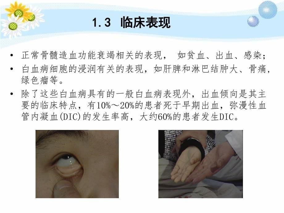 急性早幼粒白血病护理查房教学内容_第5页