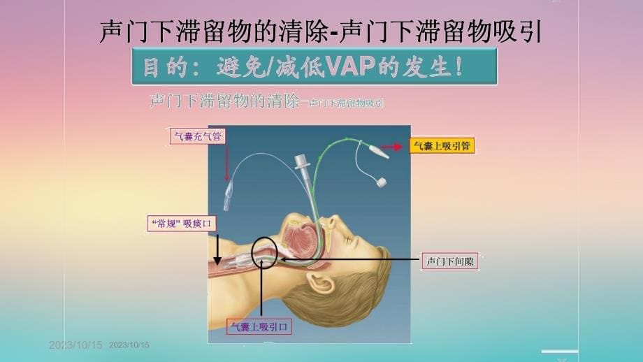 声门下吸引技术r演示教学_第5页