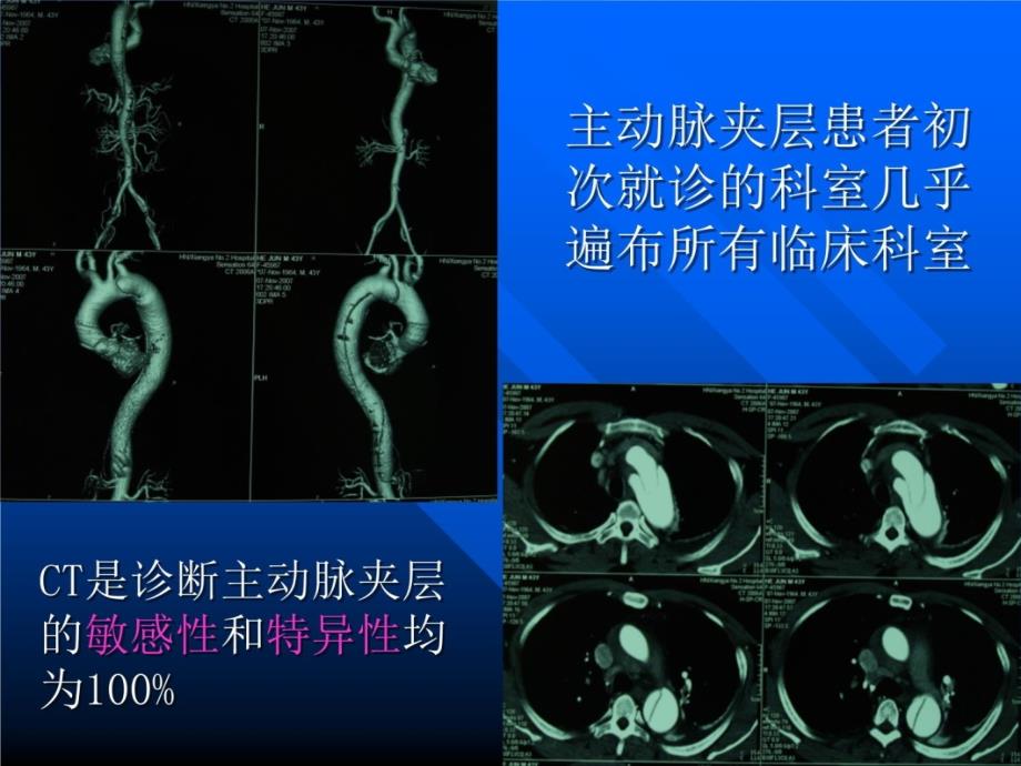 主动脉夹层知识讲解_第3页