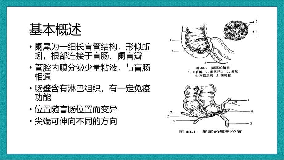 (图文)急性阑尾炎的护理查房教学课件PPT模板_第5页
