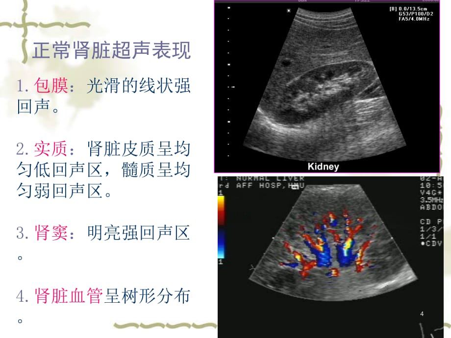 泌尿系超声课件PPT幻灯片_第4页