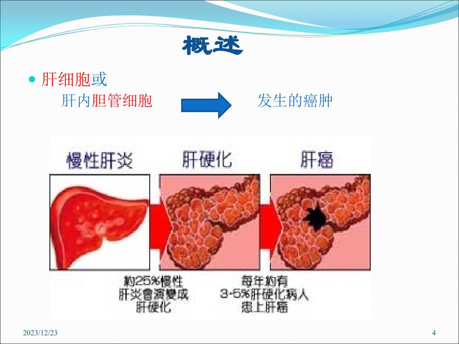 肝_癌_护_理_查_房_第4页