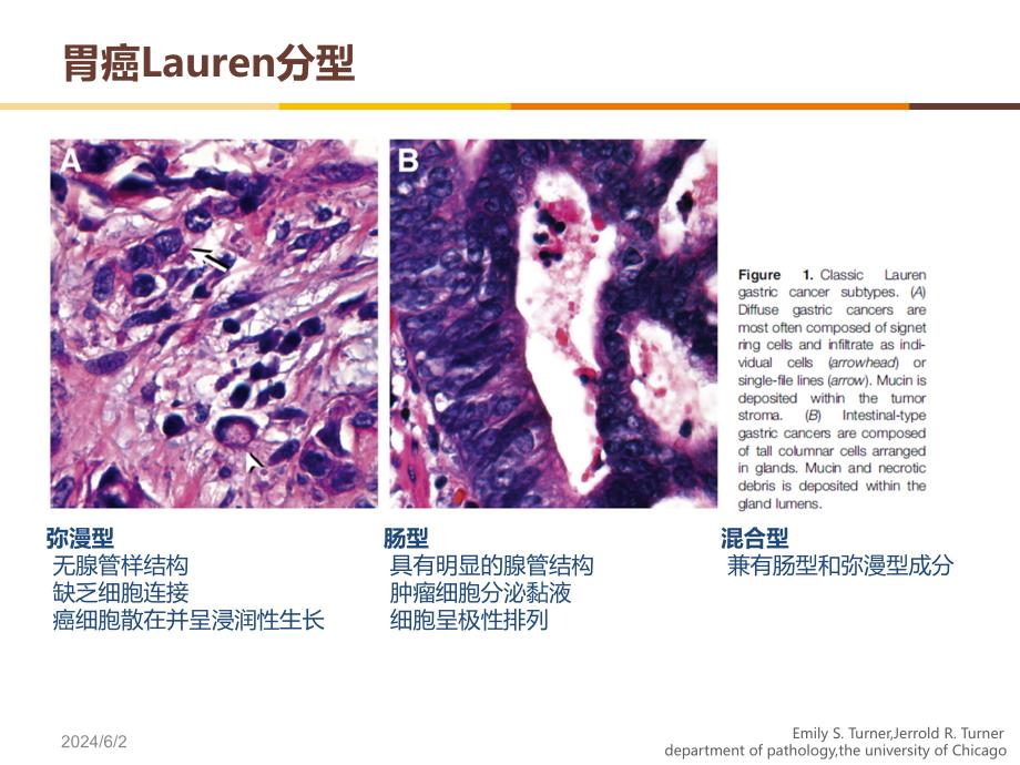 Lauren分型对胃癌治疗的价值和意义幻灯片课件_第4页