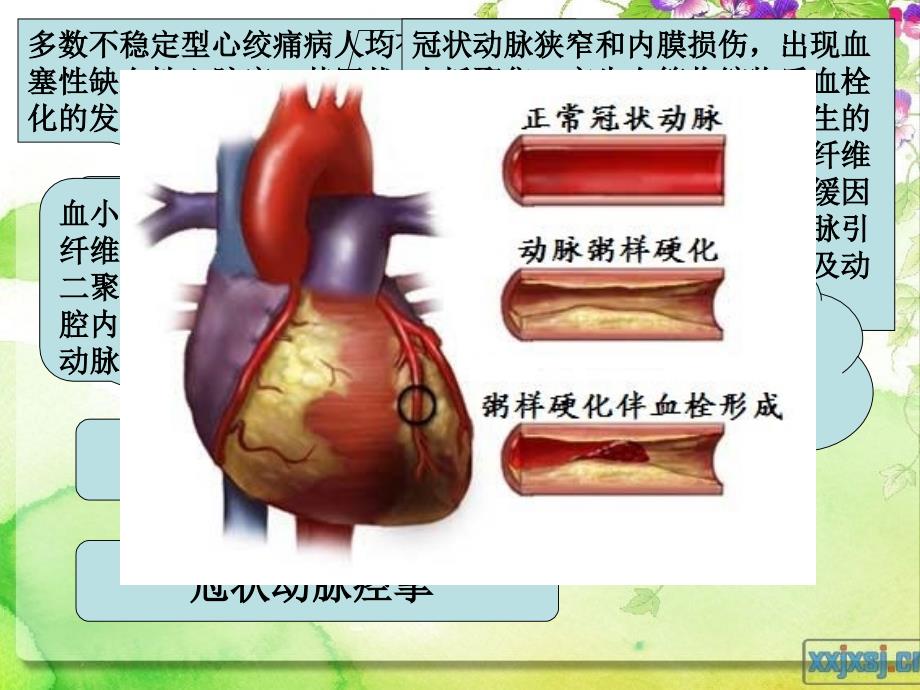 不稳定型心绞痛i知识讲解_第4页