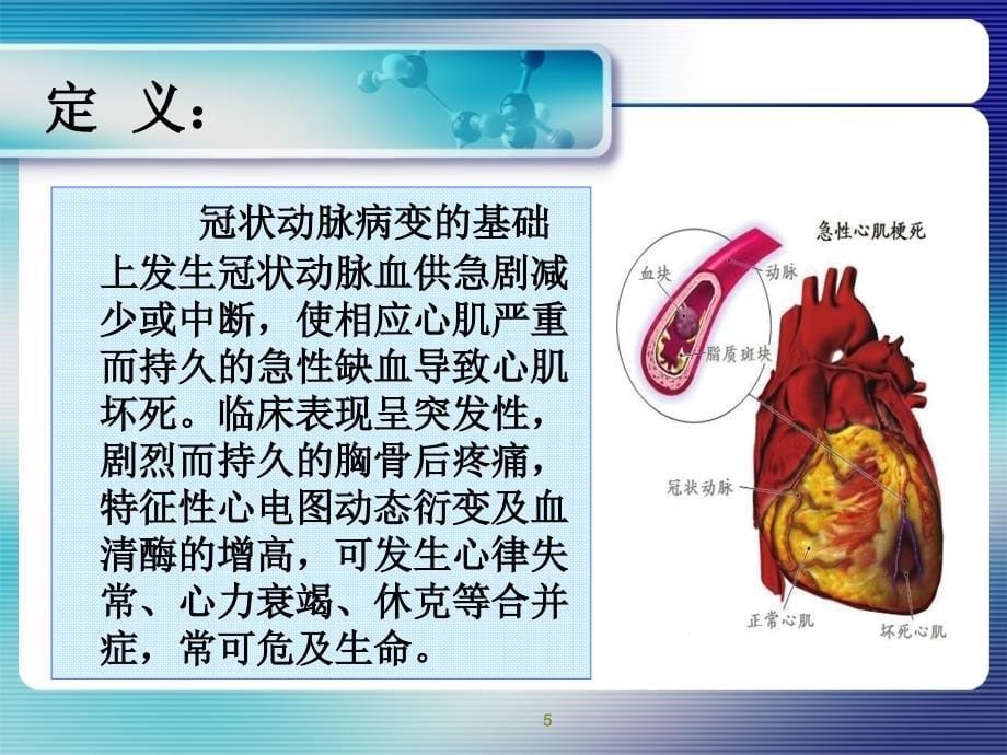 急性心肌梗死抢救护理PPT幻灯片_第5页