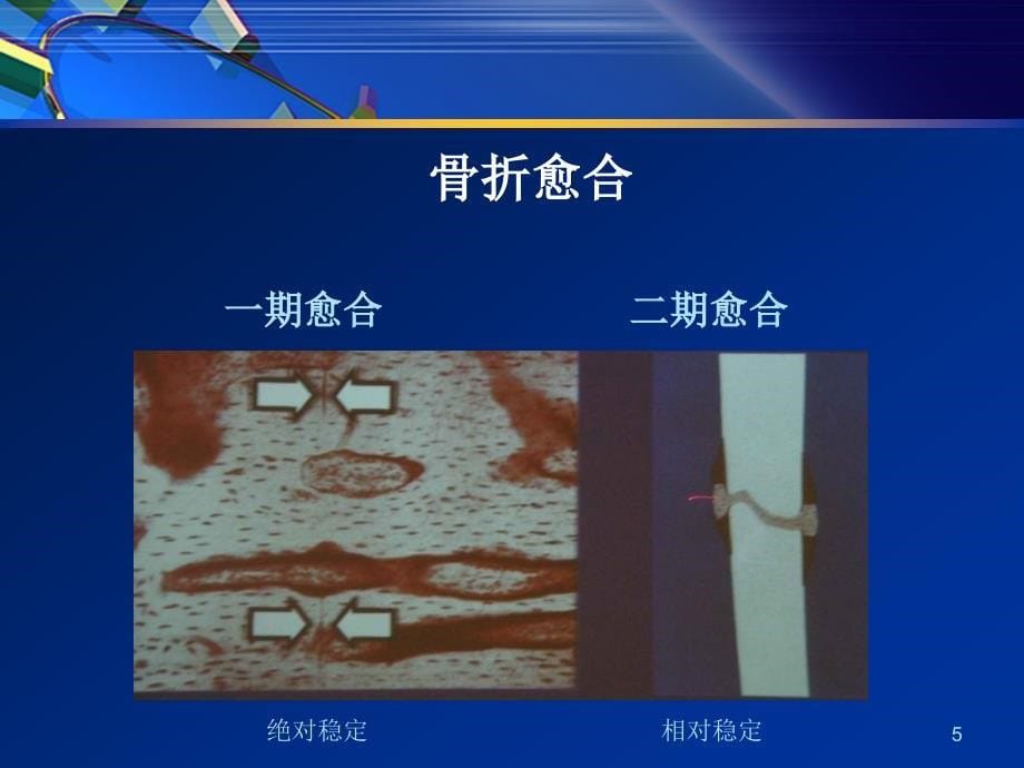 骨科内固定经典理论PPT参考课件_第5页