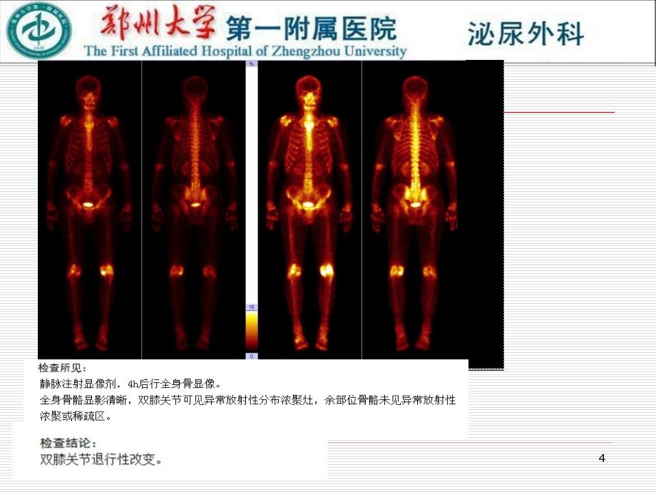 前列腺癌病例讨论PPT参考课件_第4页