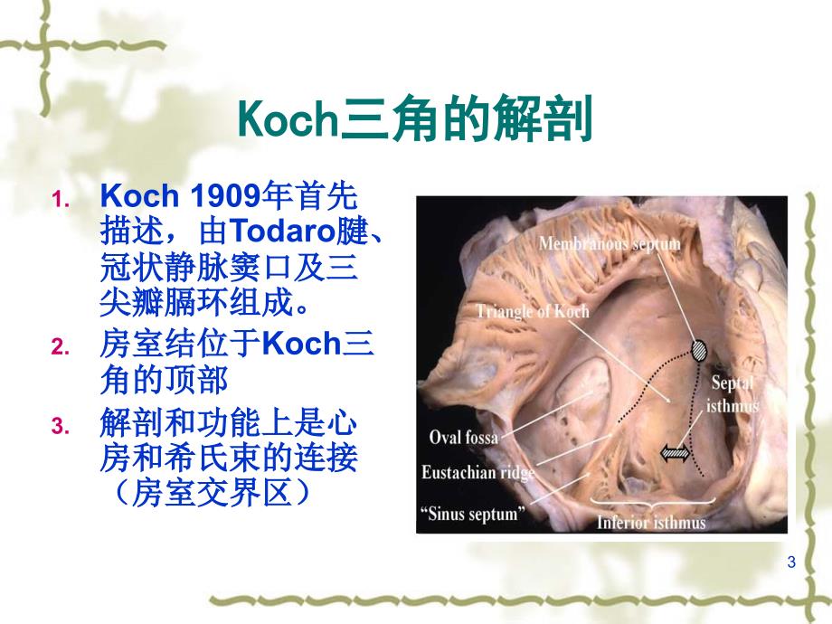 Koch 三角解剖与临床1PPT幻灯片_第3页