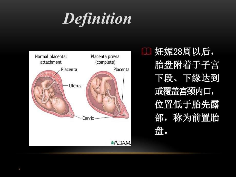 前置胎盘的诊断、预防和处理PPT参考课件_第5页