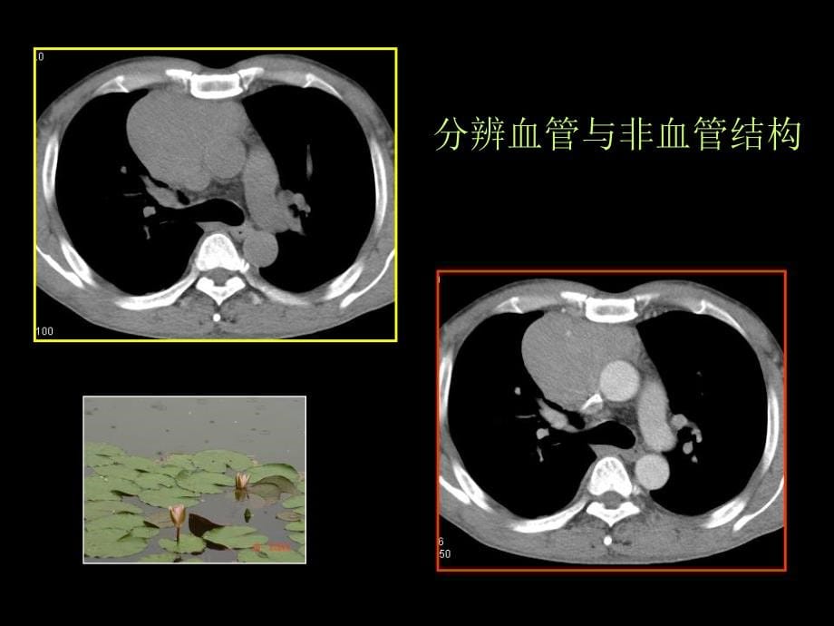 肺癌CT征象的观察与分析知识PPT课件1_第5页