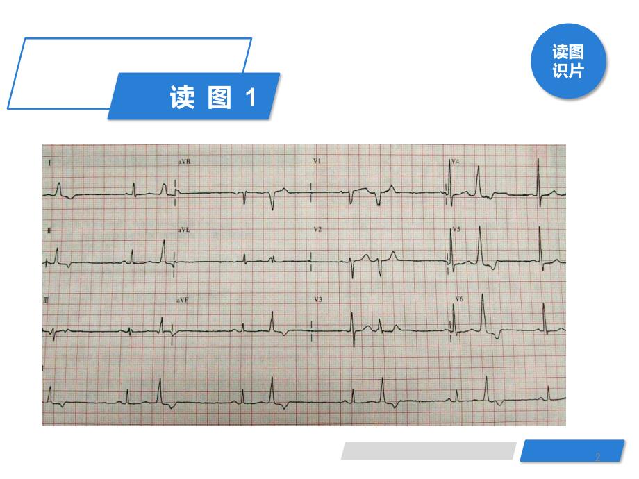 心电图(室性早搏)PPT参考课件_第2页