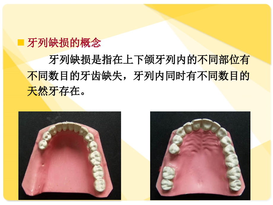 可摘局部义齿-结构精编PPT课件_第4页