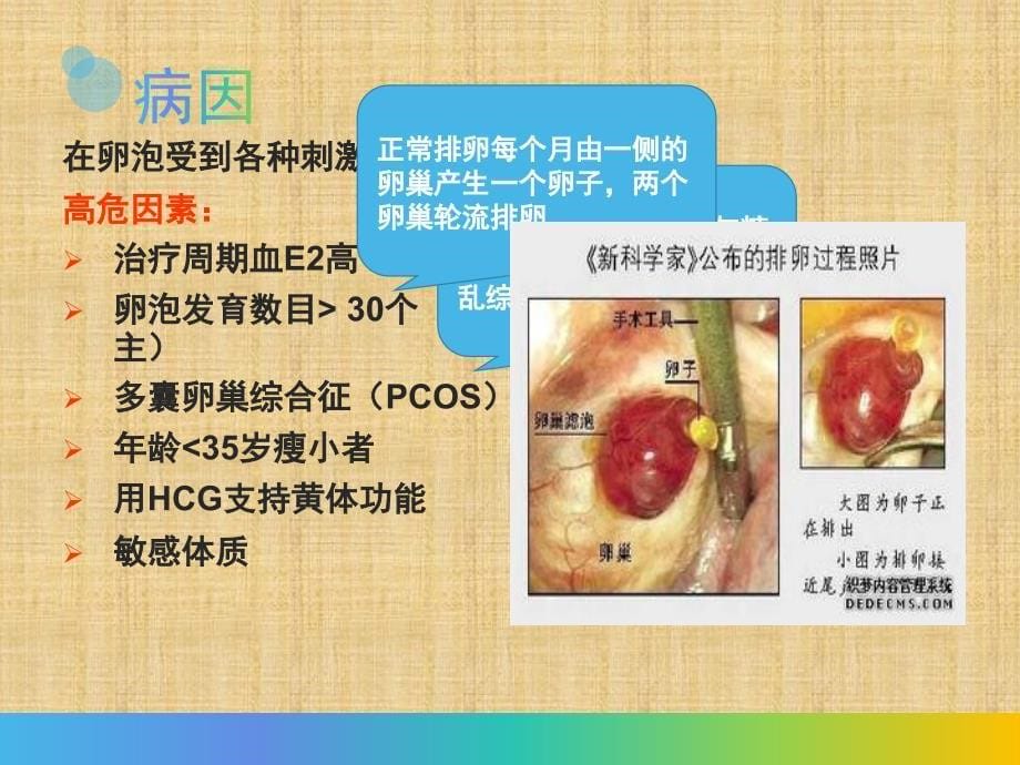 卵巢过度刺激综合征PPT精编PPT课件_第5页