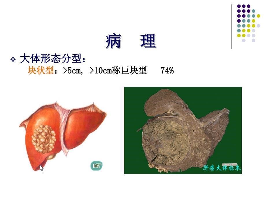 原发性肝癌-课件上课讲义_第5页