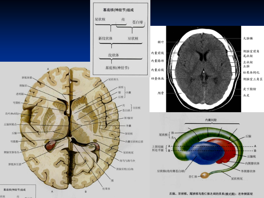 双侧丘脑对称性病变影像学精编PPT课件_第4页