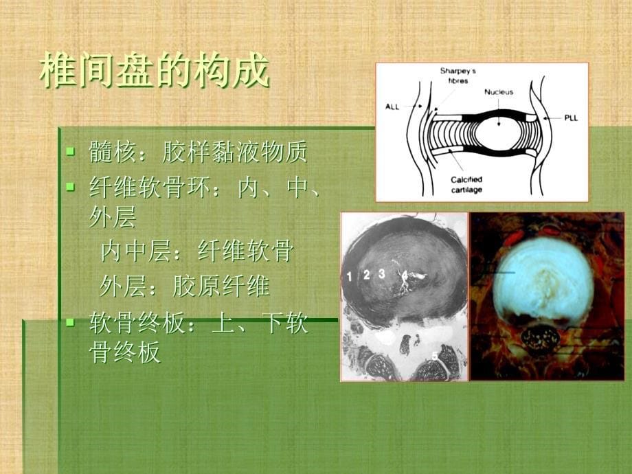 椎间盘突出的影像学诊断精编PPT课件_第5页