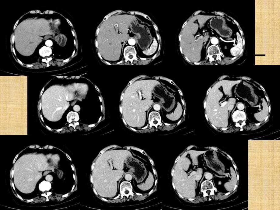 肝脏疾病影像表现精编PPT课件_第5页