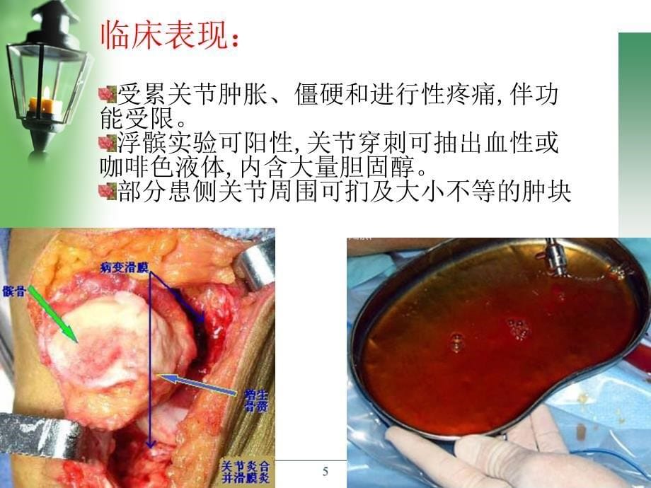 膝关节绒毛结节性滑膜炎PPT参考幻灯片_第5页