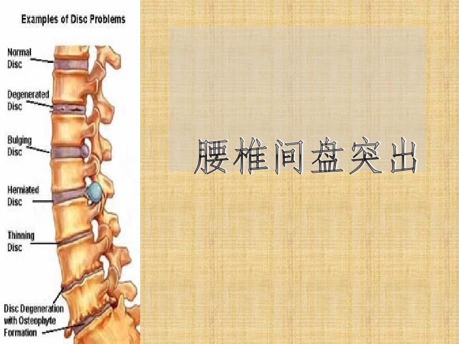 (腰椎间盘突出与腰肌劳损)运动康复精编PPT课件_第1页