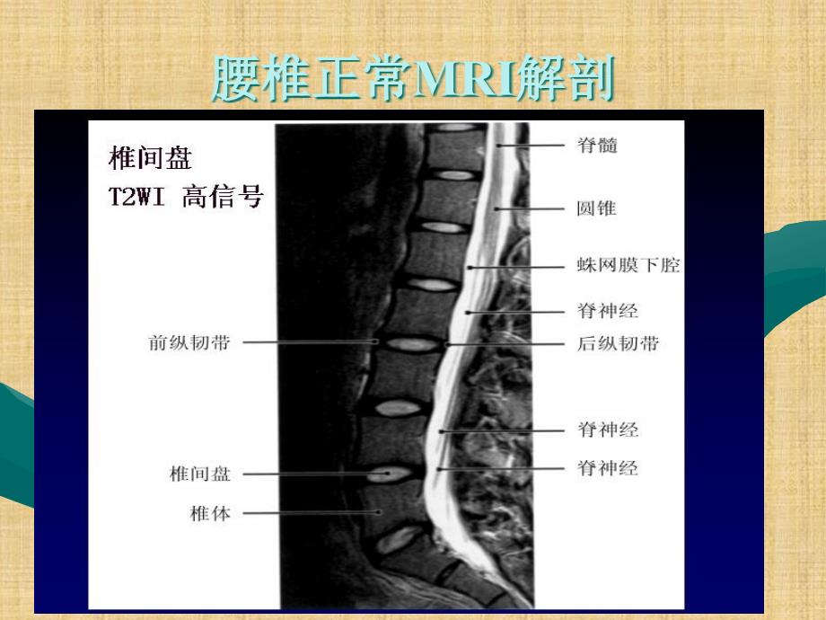 腰椎间盘的MRI诊断61652精编PPT课件_第2页