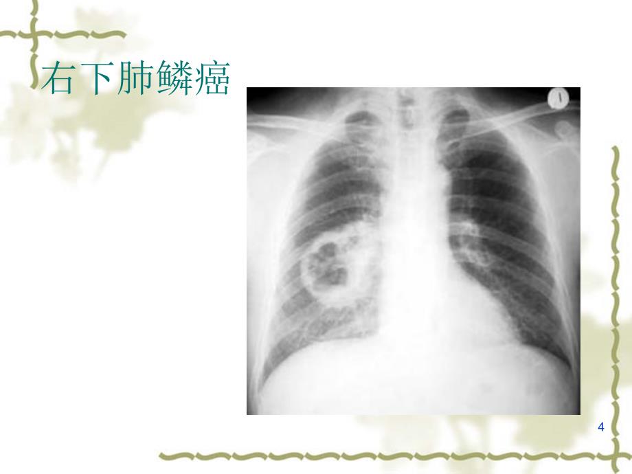 X线检查适应症PPT参考幻灯片_第4页