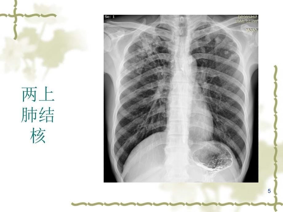 X线检查适应症PPT参考幻灯片_第5页