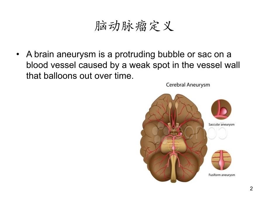 脑动脉瘤发病机制探讨PPT参考幻灯片_第2页