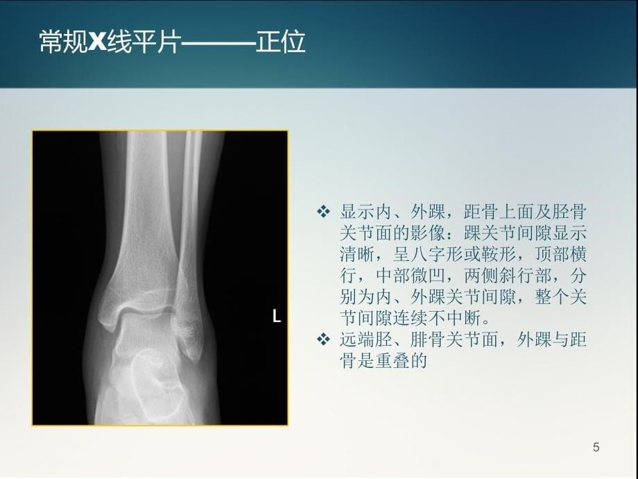 踝关节正常解剖和损伤性病变的影像表现PPT参考幻灯片_第5页