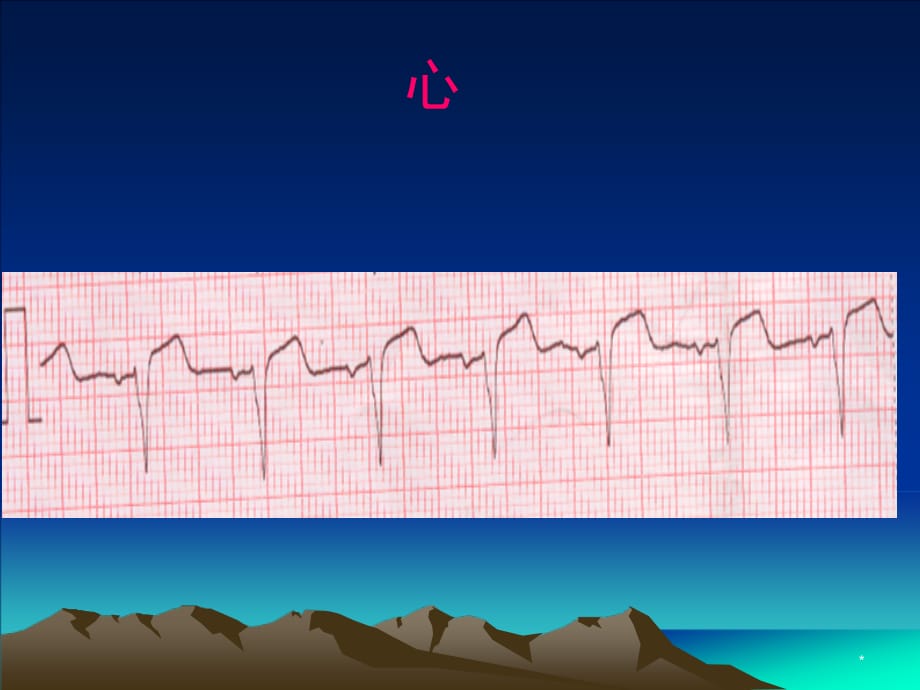心电图基本知识PPT参考幻灯片_第5页