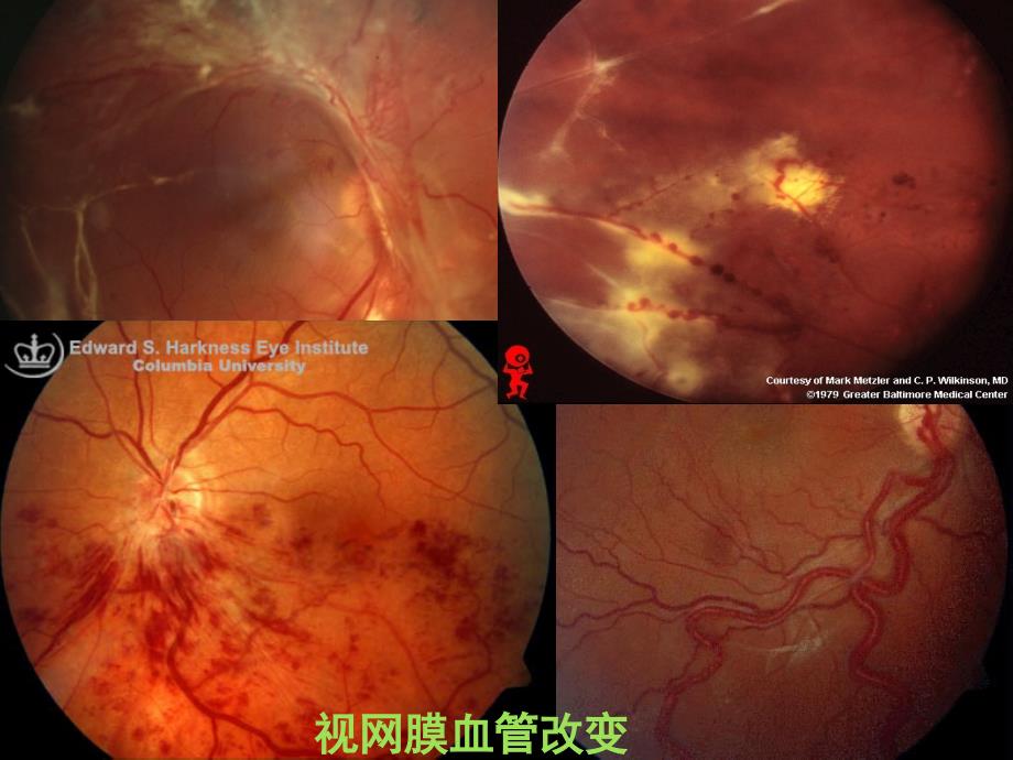 视网膜血管疾病精编PPT课件_第3页