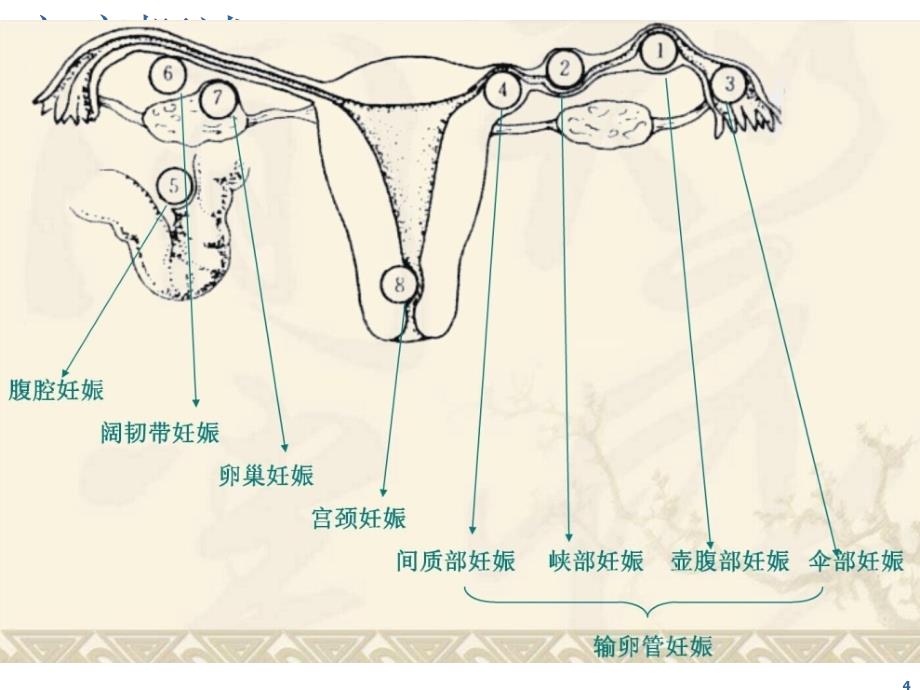 异位妊娠保守治疗护理查房PPT参考幻灯片_第4页