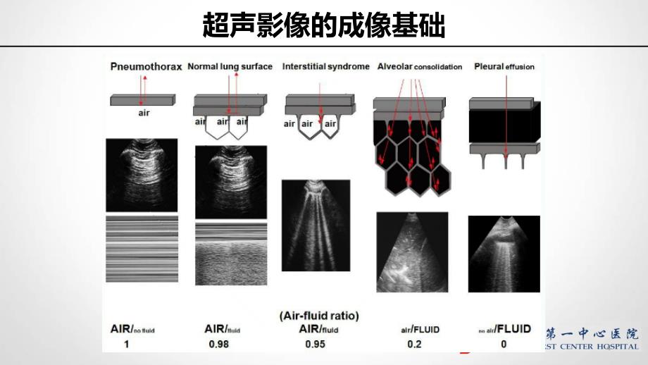 重症肺部超声PPT参考幻灯片_第4页