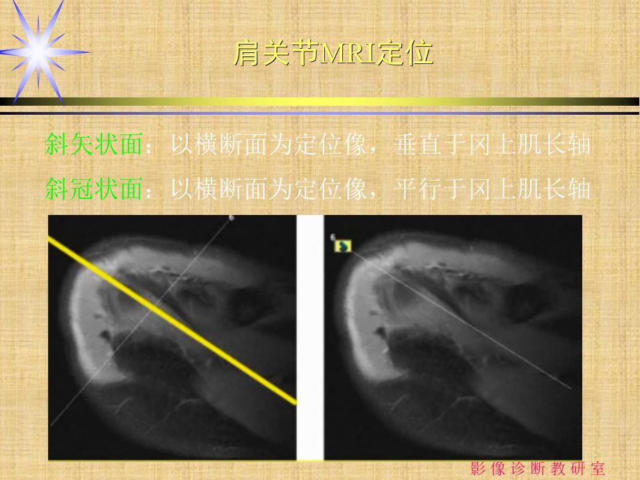 肩关节损伤的MRI诊断精编PPT课件_第3页