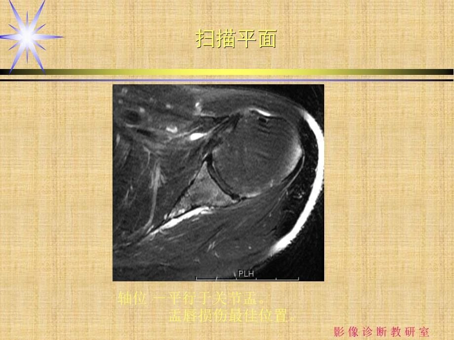 肩关节损伤的MRI诊断精编PPT课件_第5页