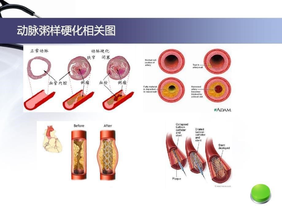 心血管系统疾病PPT参考幻灯片_第5页