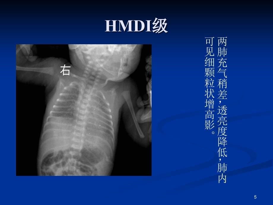 新生儿肺透明膜病的影像学诊断PPT参考幻灯片_第5页