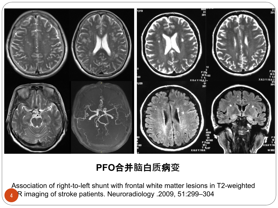 脑白质病的诊断PPT参考幻灯片_第4页