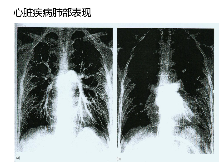 系统性疾病的肺部表现PPT参考幻灯片_第4页
