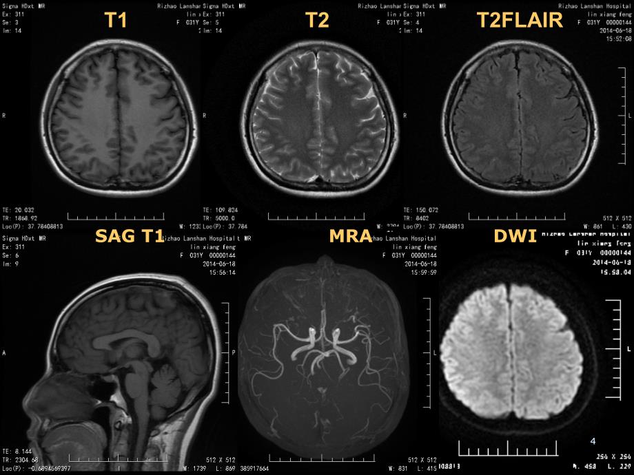 颅脑常见疾病MR表现PPT参考幻灯片_第4页