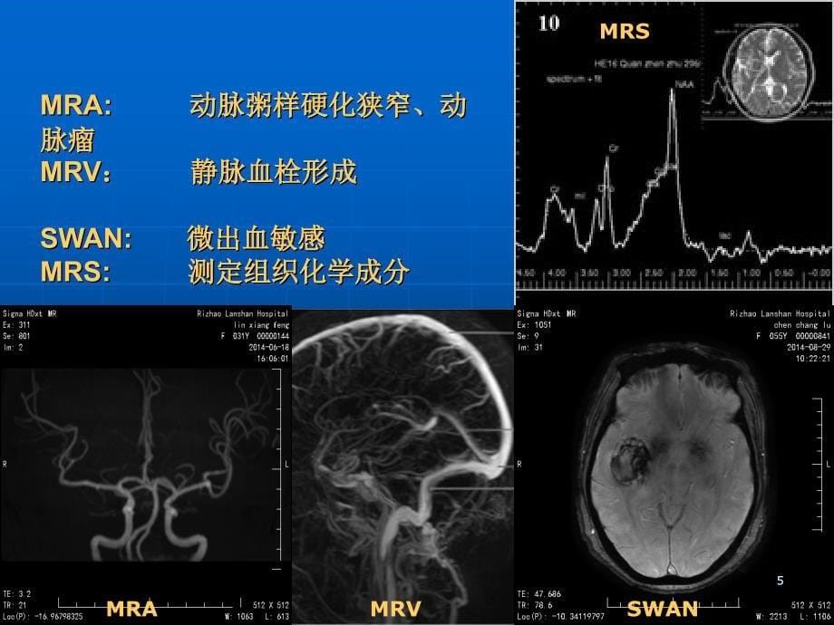 颅脑常见疾病MR表现PPT参考幻灯片_第5页