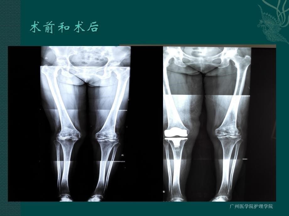 膝关节置换术的护理查房PPT参考幻灯片_第5页