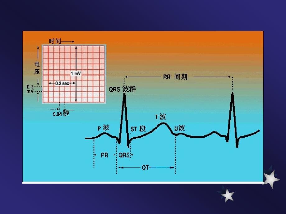 实用心电图(常见异常心电图)PPT参考幻灯片_第4页