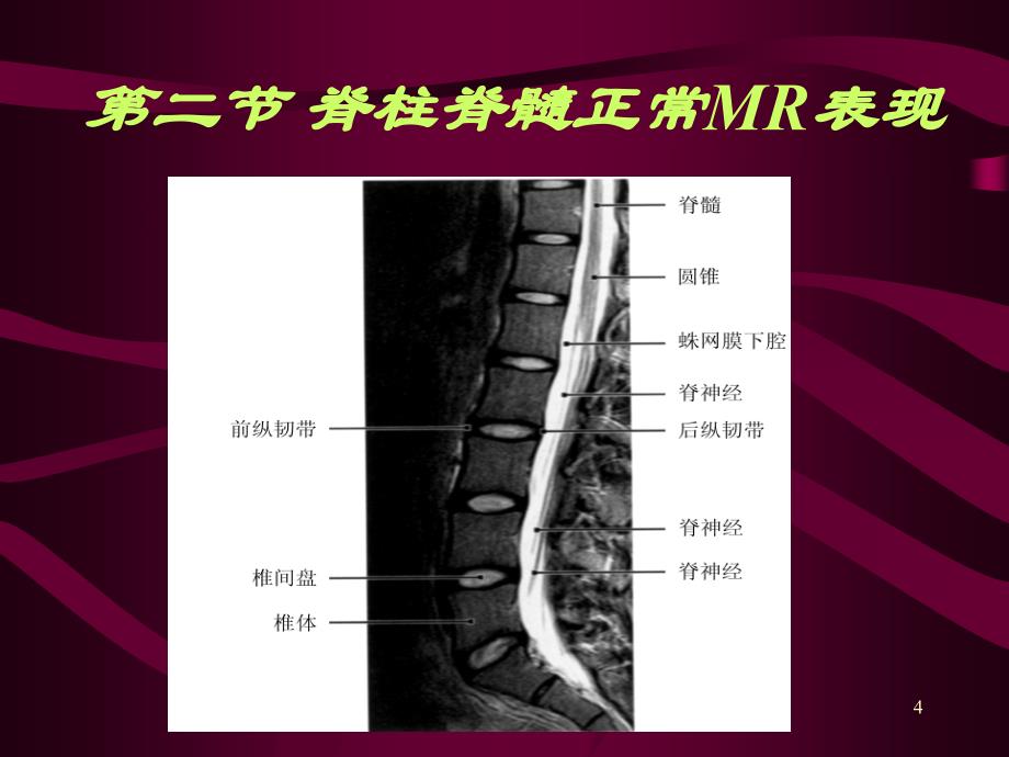 脊柱和脊髓病变MRI诊断PPT参考幻灯片_第4页