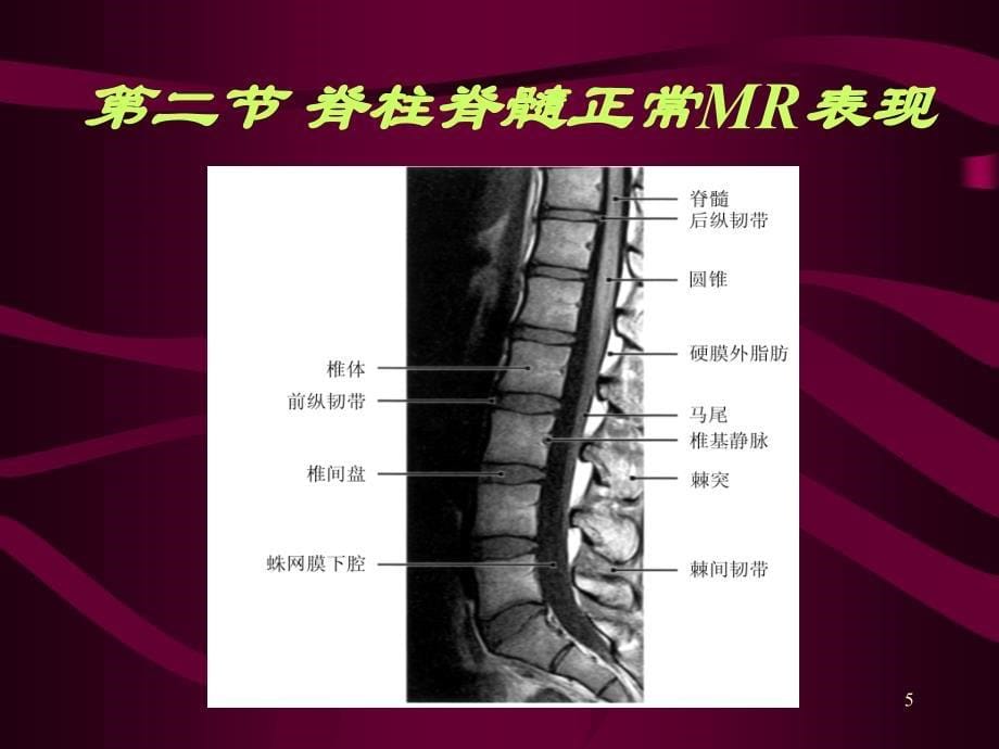 脊柱和脊髓病变MRI诊断PPT参考幻灯片_第5页