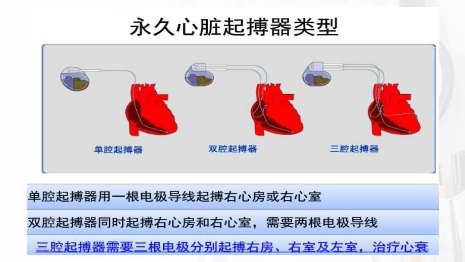 永久性心脏起搏器植入术后护理PPT参考幻灯片_第5页