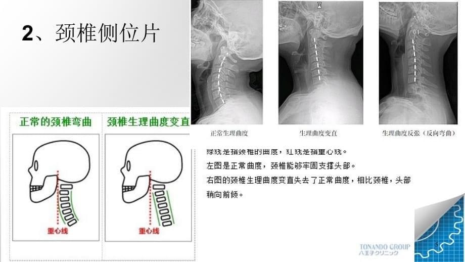 颈椎X片PPT参考幻灯片_第5页