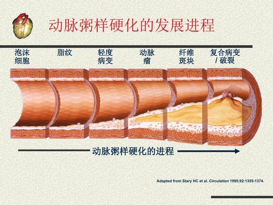 急性心肌梗死护理课件说课材料_第5页