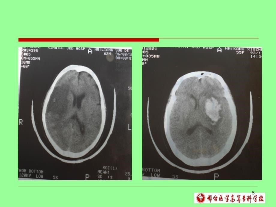 中风病的中医辨证PPT参考幻灯片_第5页